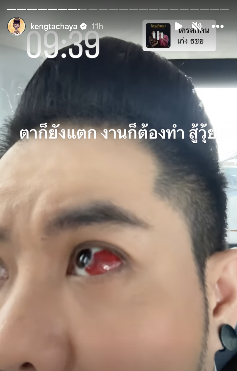 "เก่ง ธชย" เหยื่อบุตาอักเสบ ด้านแฟนๆ แห่เป็นห่วงเพียบ