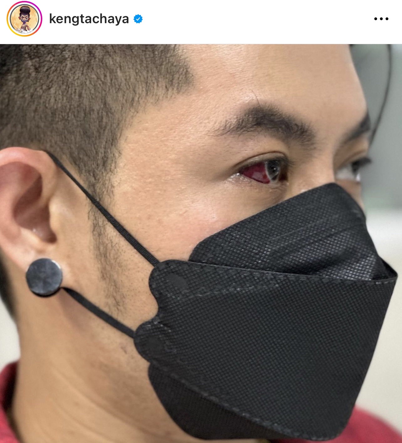 กลัวตาบอด! “เก่ง ธชย” เส้นเลือดฝอยตาขาวแตก รักษาไม่หาย หวั่นลุกลาม