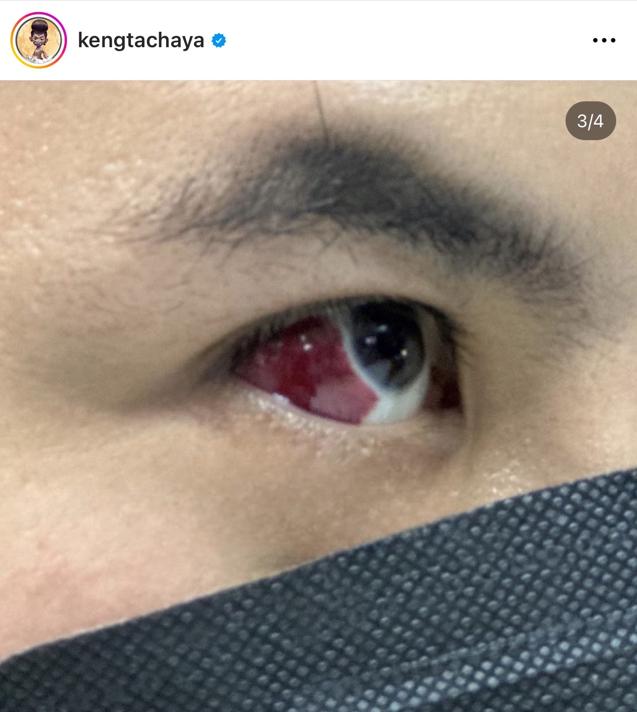 กลัวตาบอด! “เก่ง ธชย” เส้นเลือดฝอยตาขาวแตก รักษาไม่หาย หวั่นลุกลาม