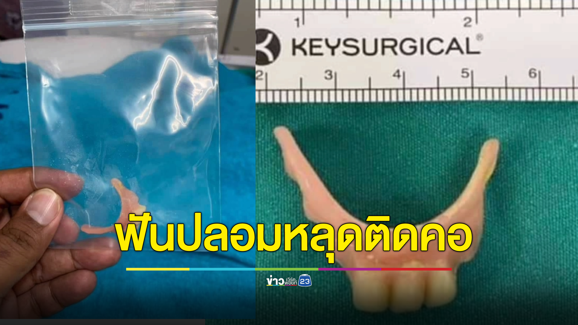 อุทาหรณ์! ฟันปลอมหลุดติดคอครูบำนาญวัย 67 แพทย์ระดมกำลังช่วยปลอดภัย
