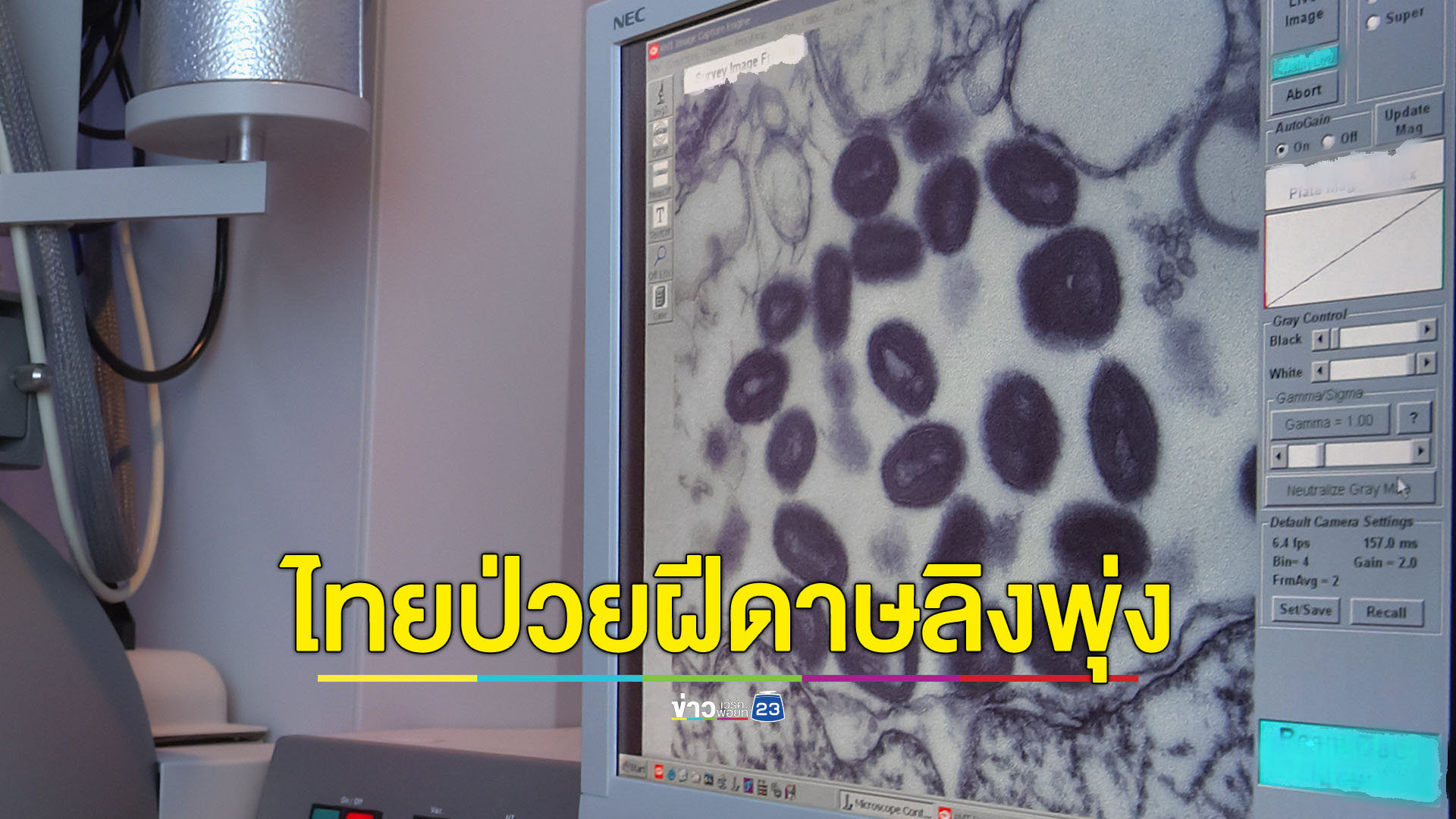 ฝีดาษลิงเริ่มวิกฤต ล่าสุดพบนักเรียนชายวัย 16 ปี ติดเชื้อ