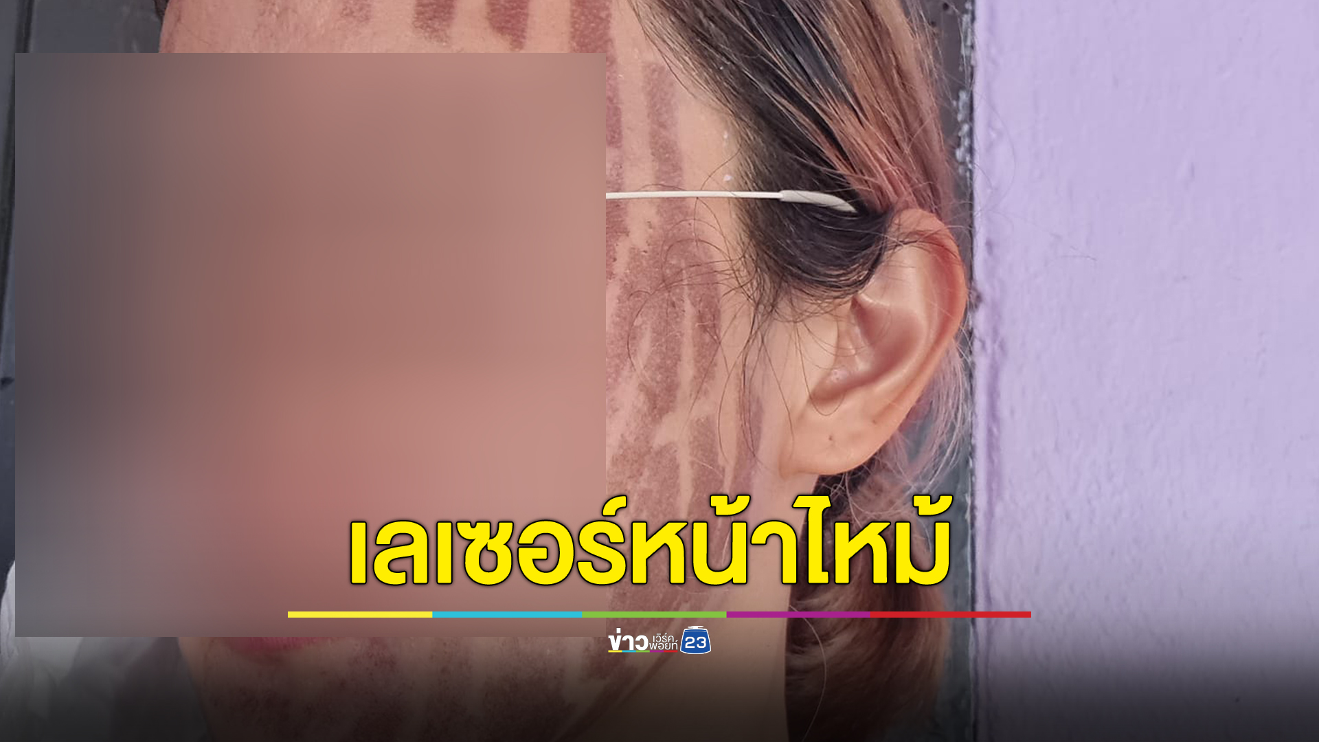 สาวโพสต์เล่าประสบการณ์กดสิวห้างแถวบ้าน ทำเลเซอร์หน้าไหม้เสียโฉม