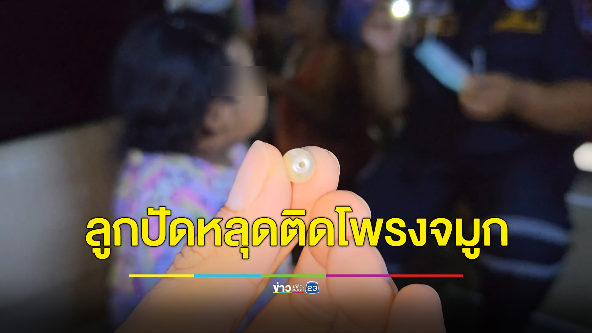 เด็กหญิง วัย 3 ขวบ ยัดลูกปัดพลาสติกขนาดเล็กหลุดคาอยู่ในโพรงจมูก