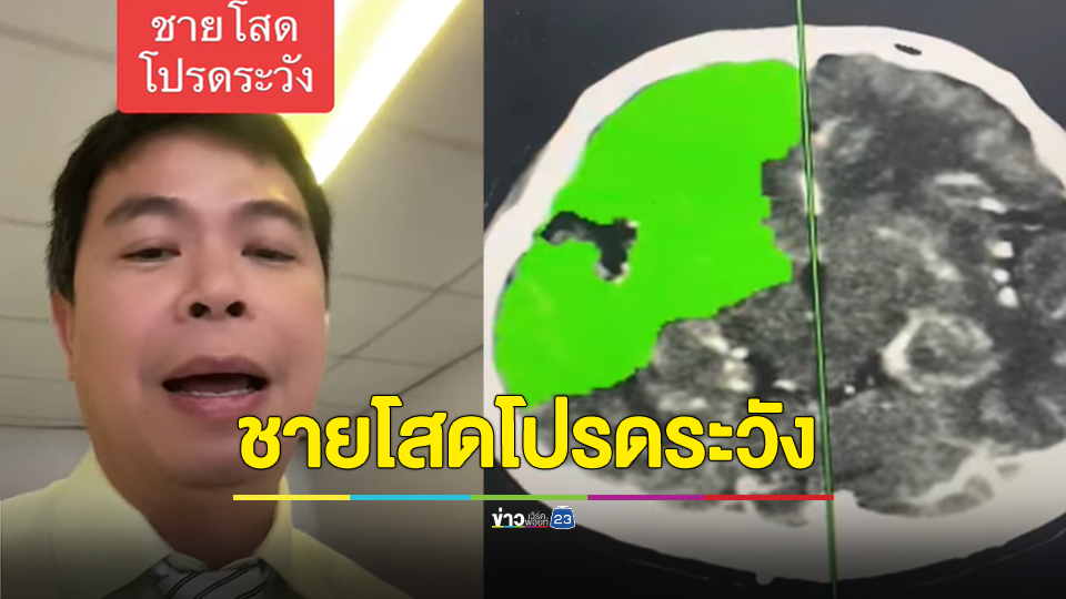 อุทาหรณ์ของคนประมาท ชายโสดโปรดระวัง เที่ยว ดื่มทุกวัน สุดท้ายสมองตายถาวร เป็นอัมพาตจากโรคหลอดเลือดสมอง
