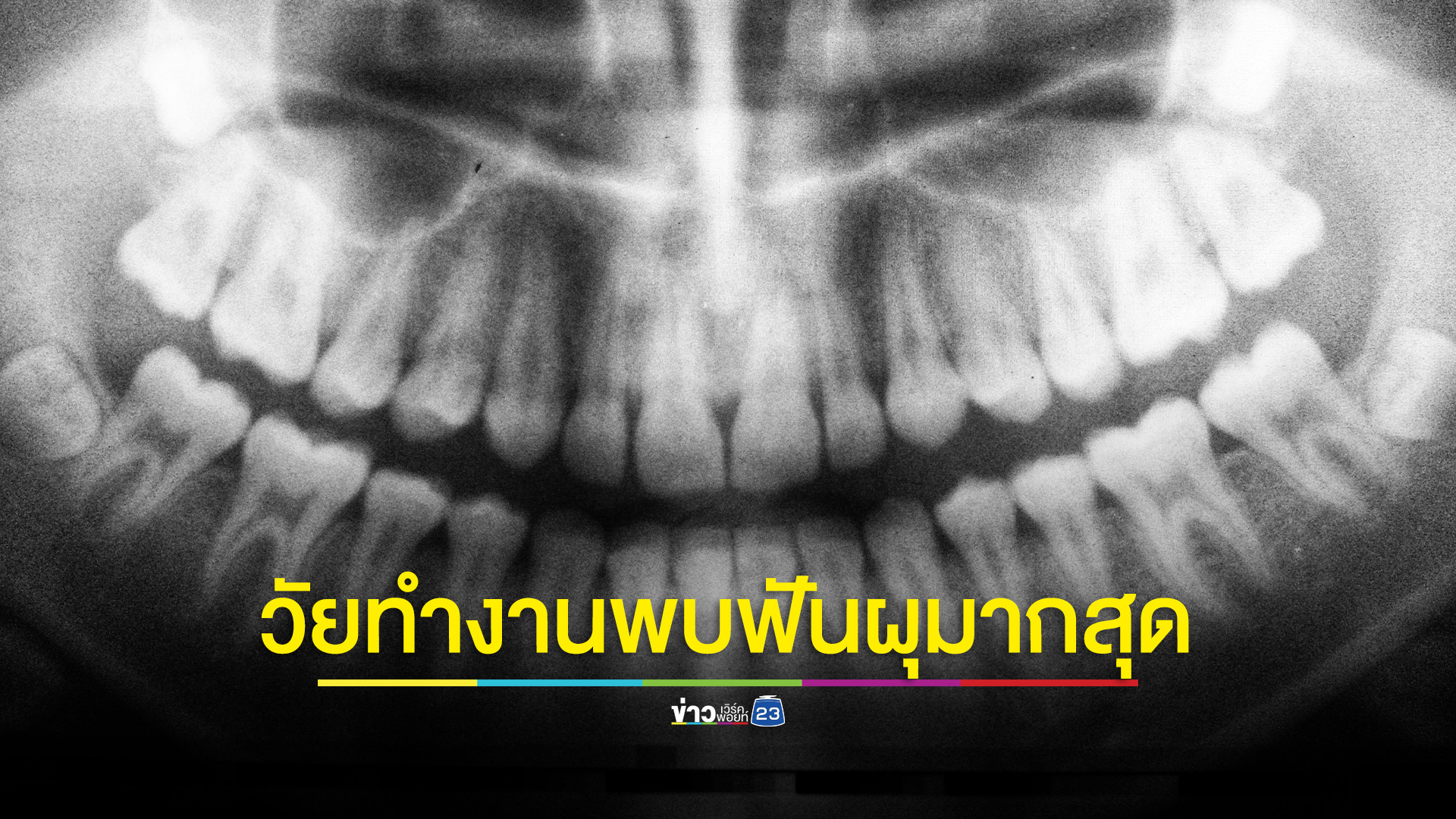 ไทยพบวัยทำงาน 'ฟันผุ' ถึง 91.8% เสี่ยงเกิดโรคแทรกซ้อน