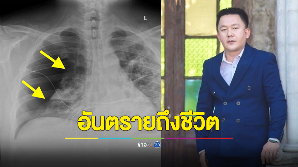 หมอหมูเตือนโรคปอดรั่วในคนอายุน้อย อันตรายร้ายแรงถึงชีวิต