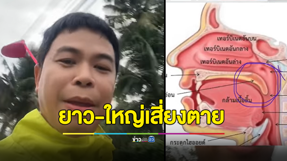 อะไรเอ่ยถ้ายาวถ้าใหญ่ จะทำให้พิการและตายง่ายกว่าคนปกติ ผู้ชายมีโอกาสเป็นมากกว่าผู้หญิง