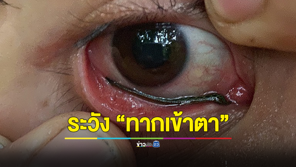 เตือนภัย! นักเดินเดินป่า หยิบกล้องขึ้นตาถ่ายรูป แม่เจ้า ถึงกับร้องเสียงหลง พบทากเข้าตา
