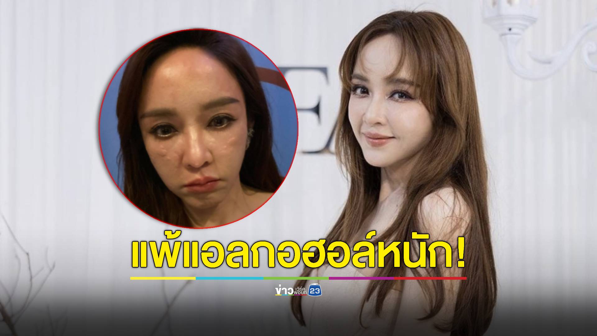 งานเข้า! "เป้ย ปานวาด" ผื่นลามขึ้นหน้า เหตุแพ้แอลกอฮอล์หนัก