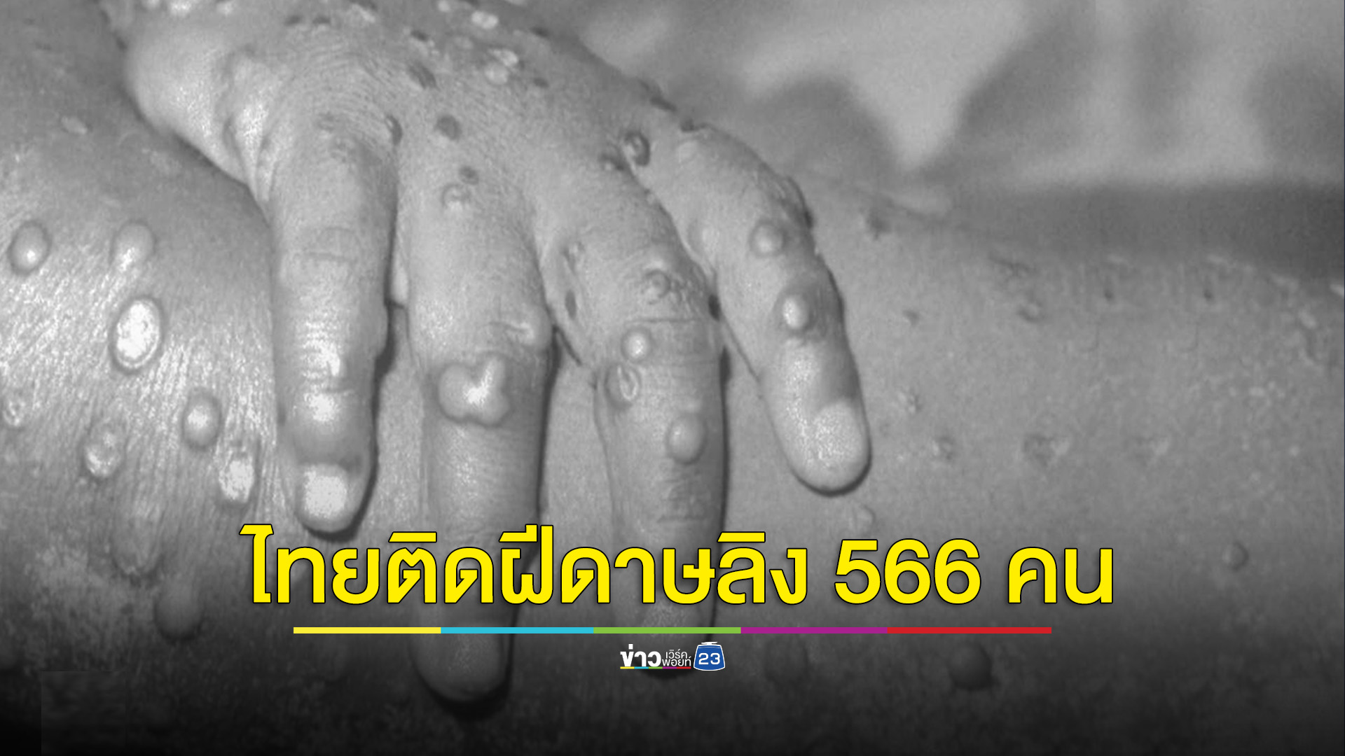 ฝีดาษลิงระบาดหนัก พบในไทยรวม 627 คน เป็นคนไทย 566 คน