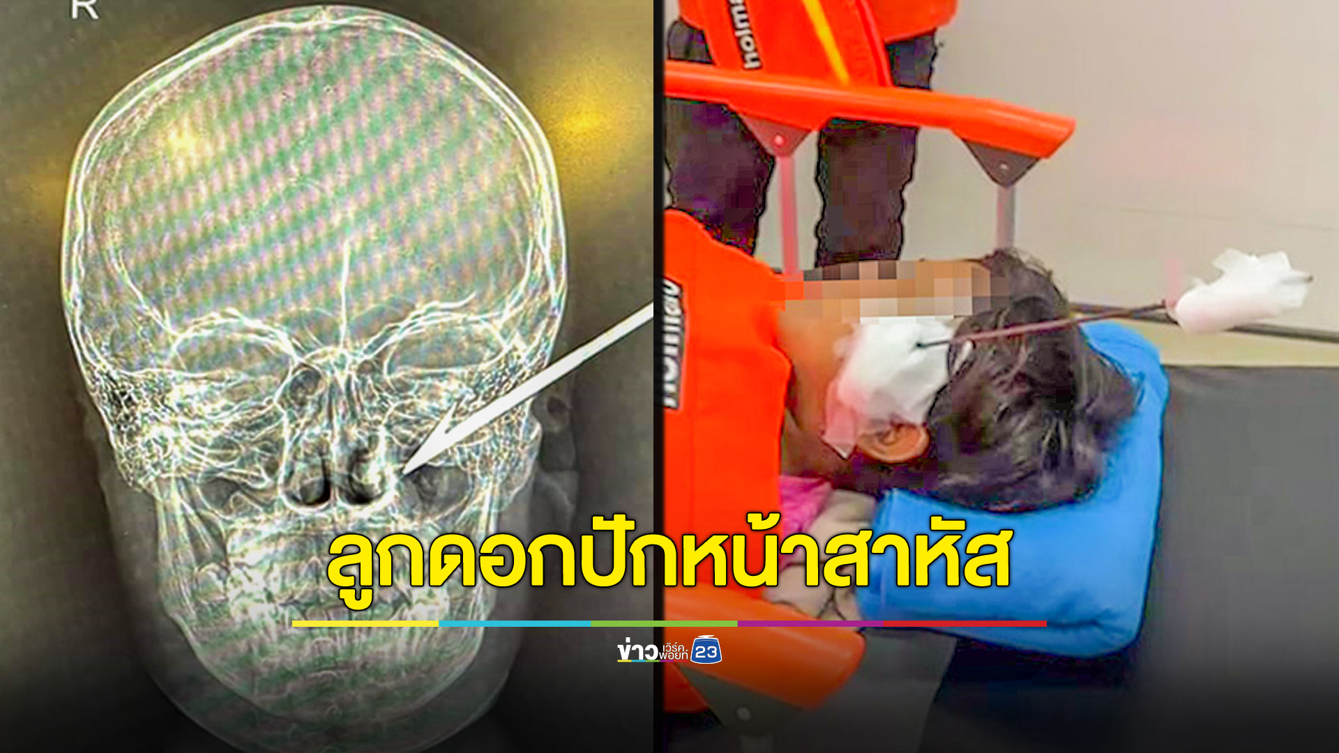 อุทาหรณ์! เด็กเล่นปืนลูกดอกยิงหนูกับเพื่อน พลาดทำลูกดอกเสียบเข้าใบหน้าเจ็บสาหัส