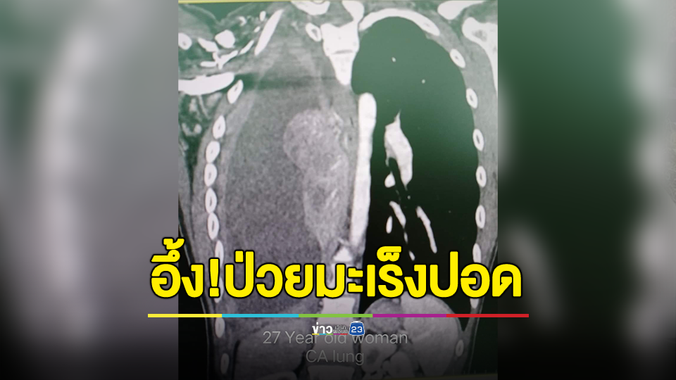 สาววัย 27 ไม่สูบบุหรี่ ตรวจพบ "มะเร็งปอด" หลังมีอาการเหนื่อย-ไอ 2 สัปดาห์