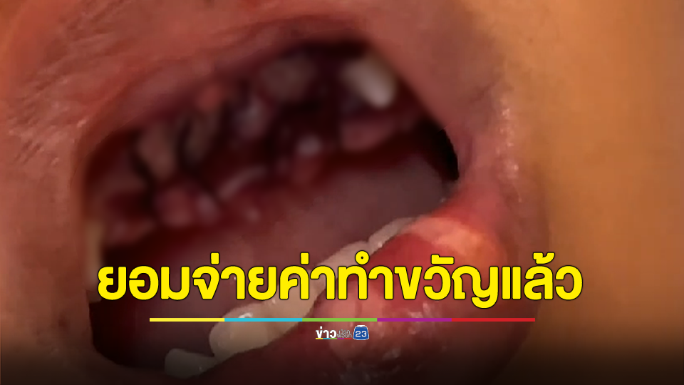 ยอมจ่ายเงินค่าทำขวัญพร้อมรักษาบาดเจ็บฟันหักแล้ว! ม. 2 โหดเตะปากเด็ก ป. 5 ฟันกระเด็นหัก 4 ซี่