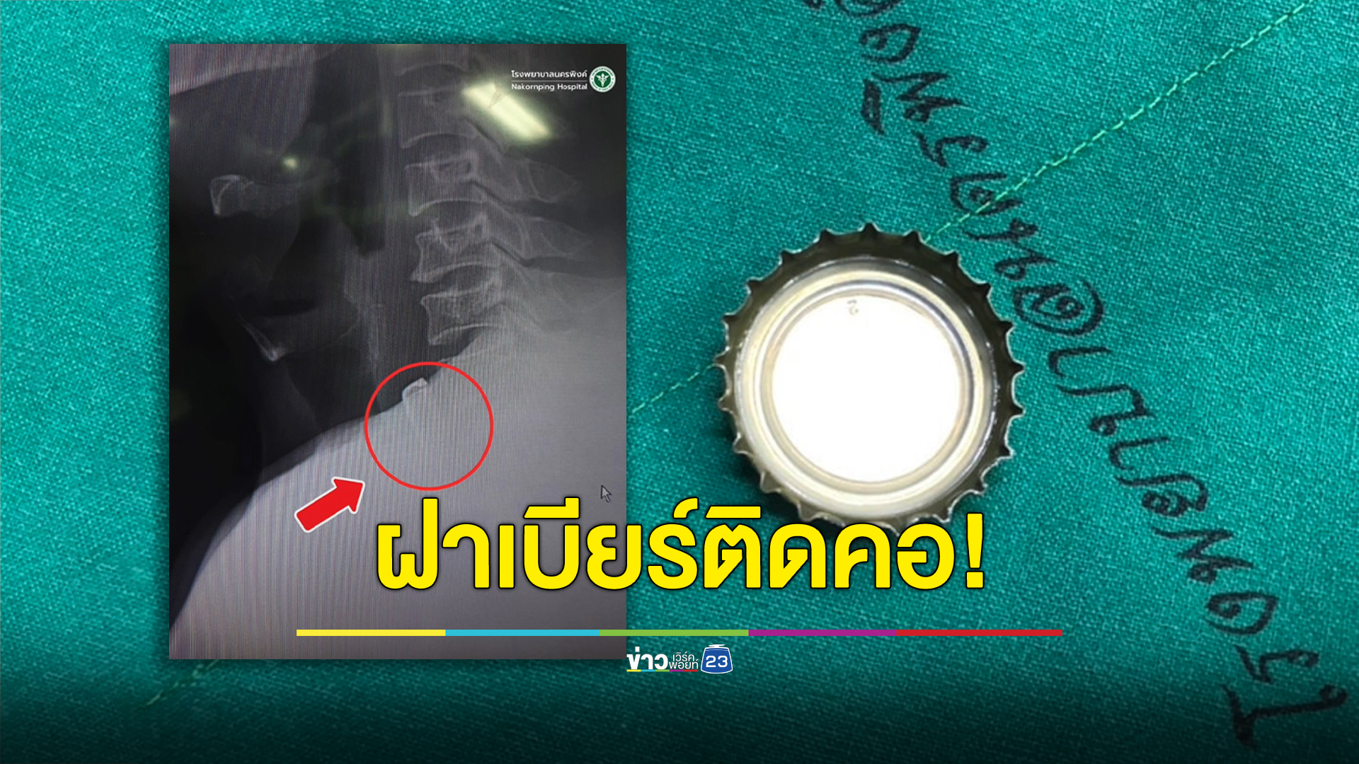 หนุ่มฉลองปีใหม่ เผลอกลืนฝาเบียร์ติดคาหลอดอาหาร