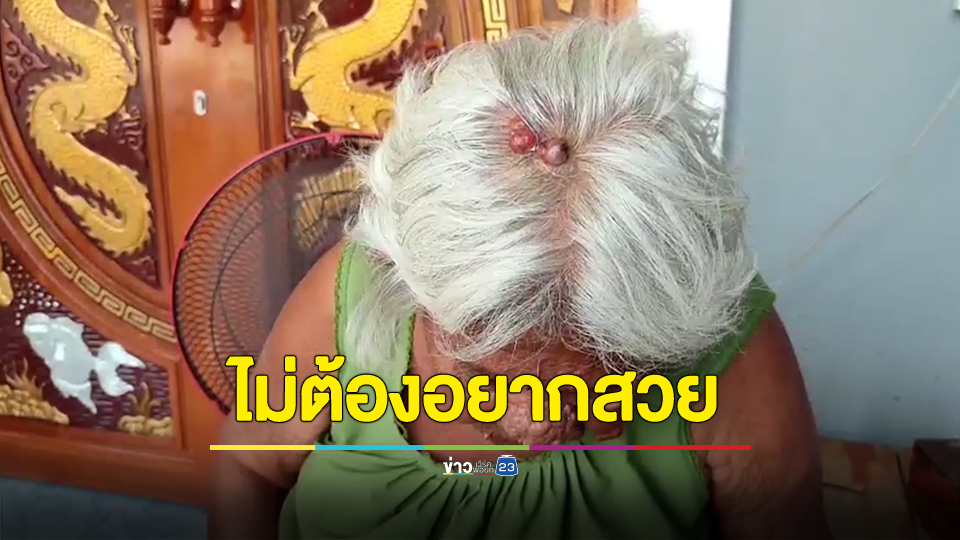ยายสุดช้ำตุ่มขึ้นตามหัว-ใบหน้าไปรพ. หมอบอกว่ารักษาไม่ได้ ไม่ต้องอยากสวยหรอก