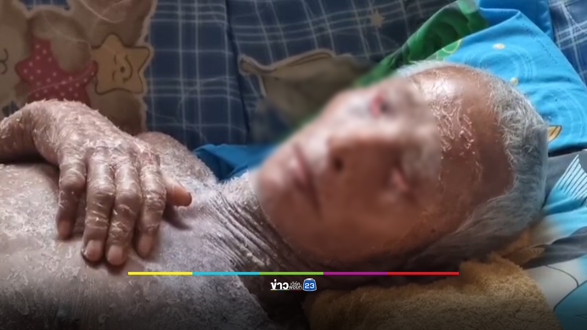 ชายชราแพ้ยาจนกลายเป็นโรคดักแด้ จำใจจำนำมือถือหาเงินค่ารักษา