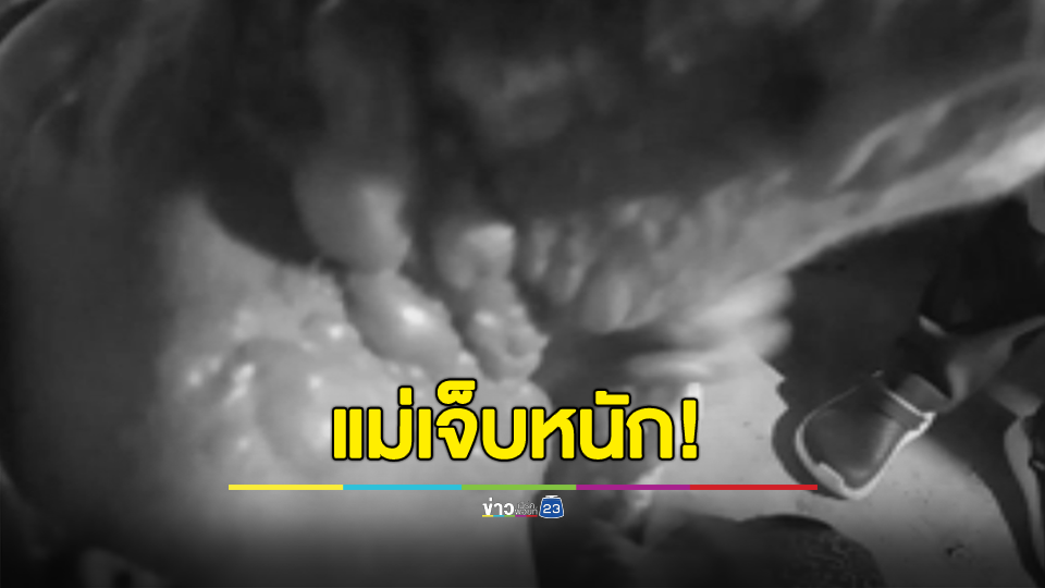ลูกเมาเอาน้ำร้อนราดหัวแม่เจ็บหนักเข้าโรงพยาบาล