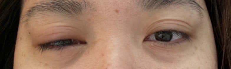 หวิดตาบอดเพราะน้ำประปาคอนโดฯ ยอดติดเชื้อพุ่งเฉียดร้อย
