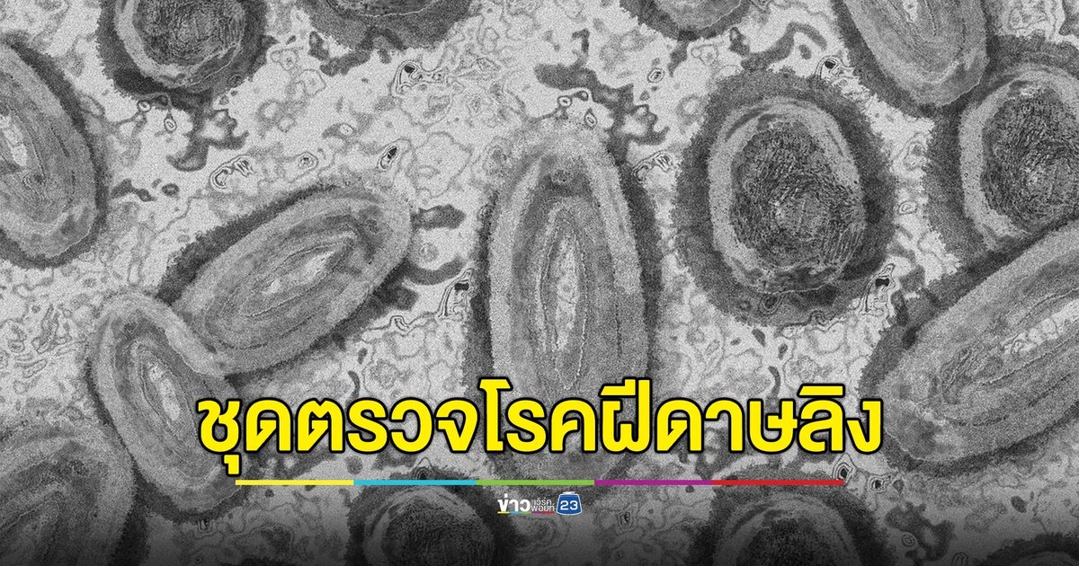 เช็กที่นี่! อย. เปิดช่องทางขึ้นทะเบียน"ชุดตรวจโรคฝีดาษลิง"
