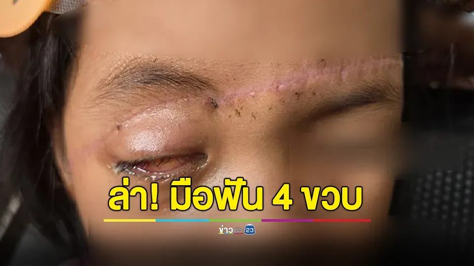 แม่ร้อง! ลูกสาว 4 ขวบ ถูกคนร้ายฟันสาหัสตาบอด- เย็บกว่า 50 เข็ม