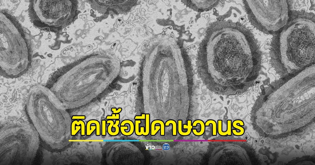 จับตา!"ฝีดาษวานร"พบป่วยแล้ว 4 ราย เตือนกลุ่มเสี่ยง