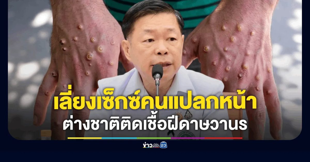 สธ. เผยต่างชาติติดเชื้อฝีดาษวานร เตือนกลุ่ม MSM เลี่ยงเซ็กซ์คนแปลกหน้า