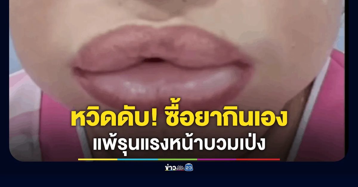 สาวระยองปวดขาซื้อยากินเอง แพ้รุนแรงหน้าบวมเป่ง-หายใจไม่ออก