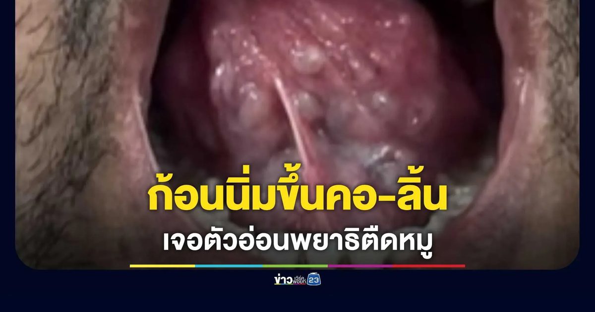 หมอยกเคส! คนไข้ชายมีก้อนนิ่มที่คอ-ลิ้น ร่วมกับอาการชัก สุดท้ายตรวจเจอตัวอ่อน "พยาธิตืดหมู"