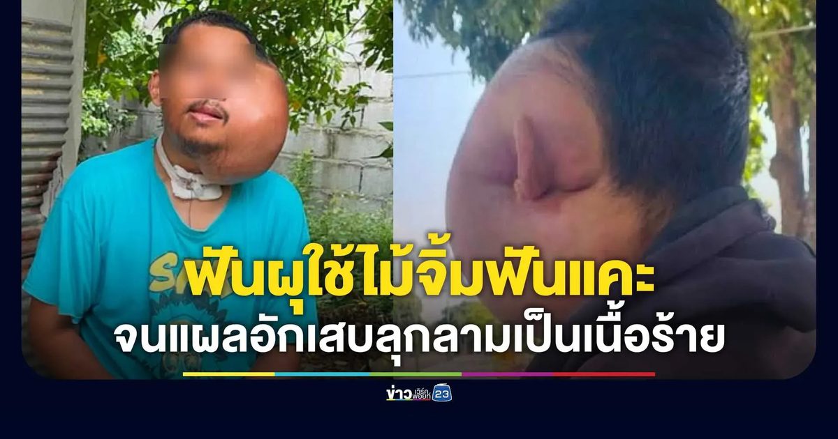 อุทาหรณ์ฟันผุ! หนุ่มใช้ไม้จิ้มฟันแคะบ่อยจนอักเสบ ลุกลามเป็นเนื้อร้าย