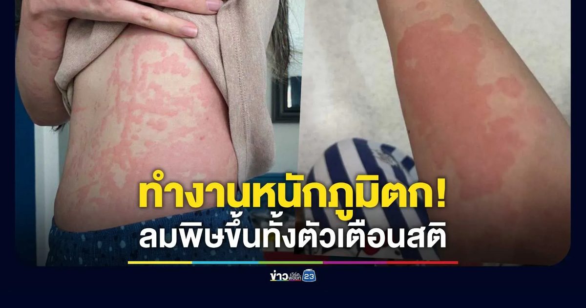 สาวโพสต์อุทาหรณ์! ทำงานหนัก-พักผ่อนน้อย ภูมิตกจนลมพิษขึ้นทั้งตัว