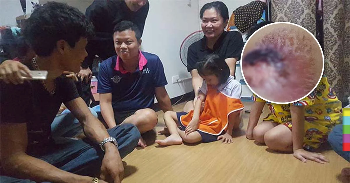 ด.ญ.วัย 6 ขวบ โดนท่อไอเสียรถ จยย.เป็นแผลพุพอง อึ้งพบตัวเลขโผล่บนปากแผล