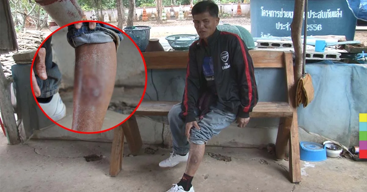 ชาวหนองบัวลำภู ป่วยหนังเน่า เชื่อต้นเหตุเป็นยาฆ่าหญ้า