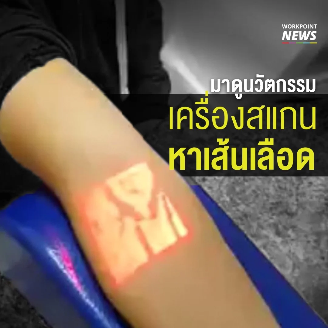 นวัตกรรมใหม่ เครื่องสแกนหาเส้นเลือด