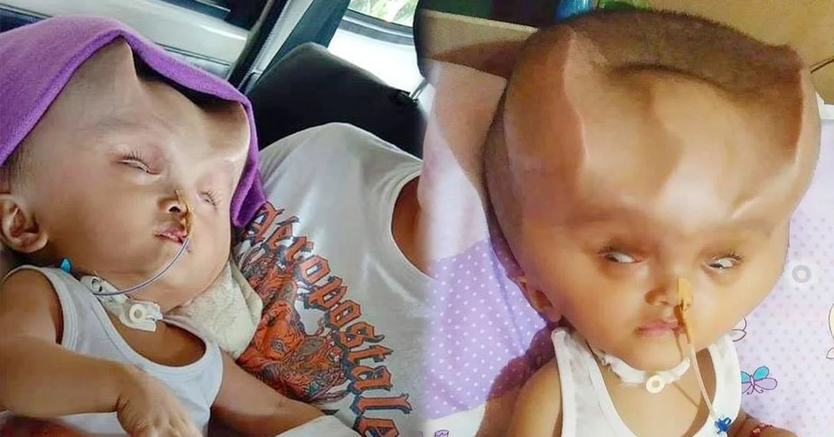 สุดเวทนา ! เด็กป่วย “โรคสมองหายาก” ผ่าตัดแล้วกะโหลกยุบ มีเขาคล้ายปีศาจ