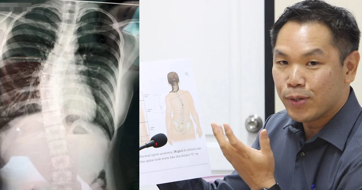 กระเป๋าหนักไม่เกี่ยวกระดูกหลังคด แต่เด็กหญิงมีความเสี่ยง 2 ใน 100 คน